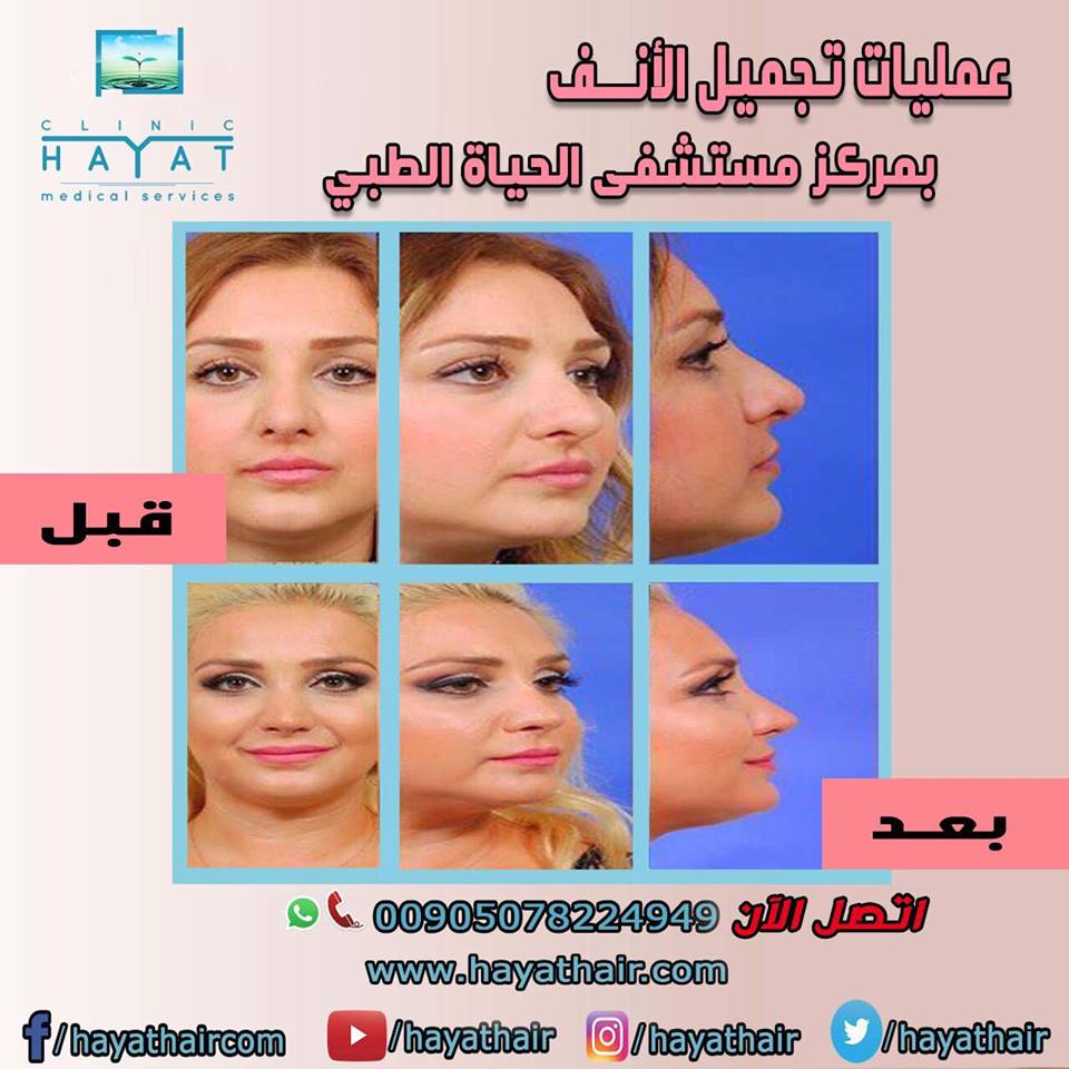 تجميل الانف في تركيا