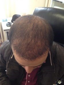 تجارب زراعة الشعر للرجال في تركيا