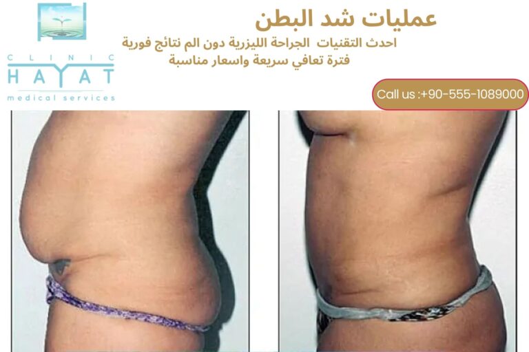 شد البطن في تركيا