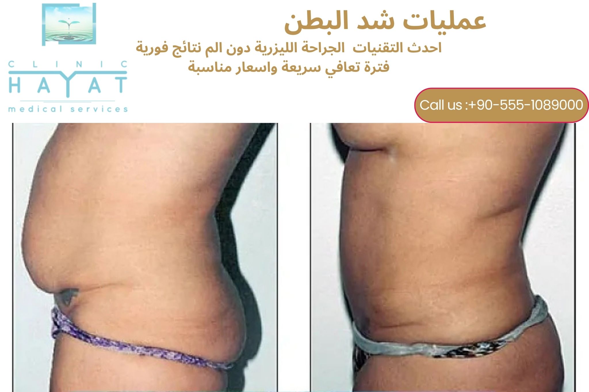 شد البطن في تركيا