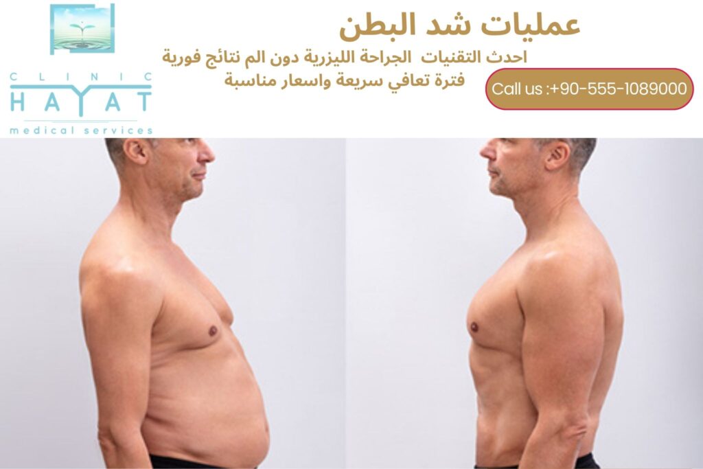 شد البطن في تركيا