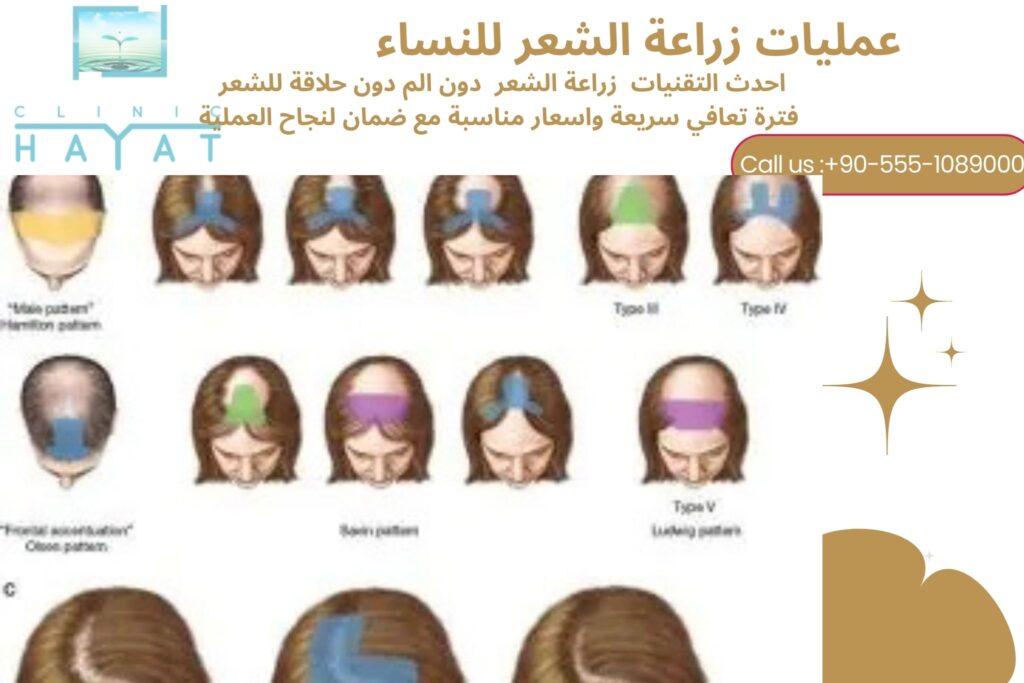 زراعة الشعر للنساء في تركيا