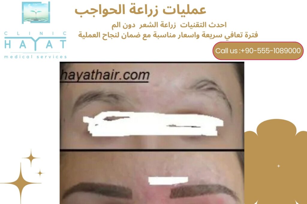 زراعة الحواجب في تركيا