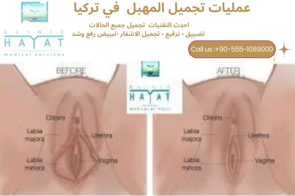 صور قبل وبعد عمليات تجميل المهبل في تركيا