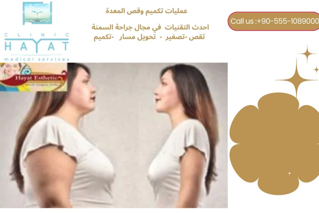 عملية تصغير المعدة في تركيا