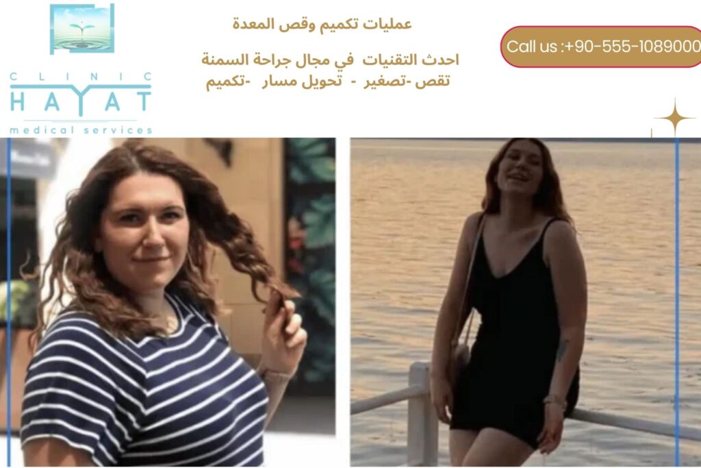 قص المعدة في تركيا