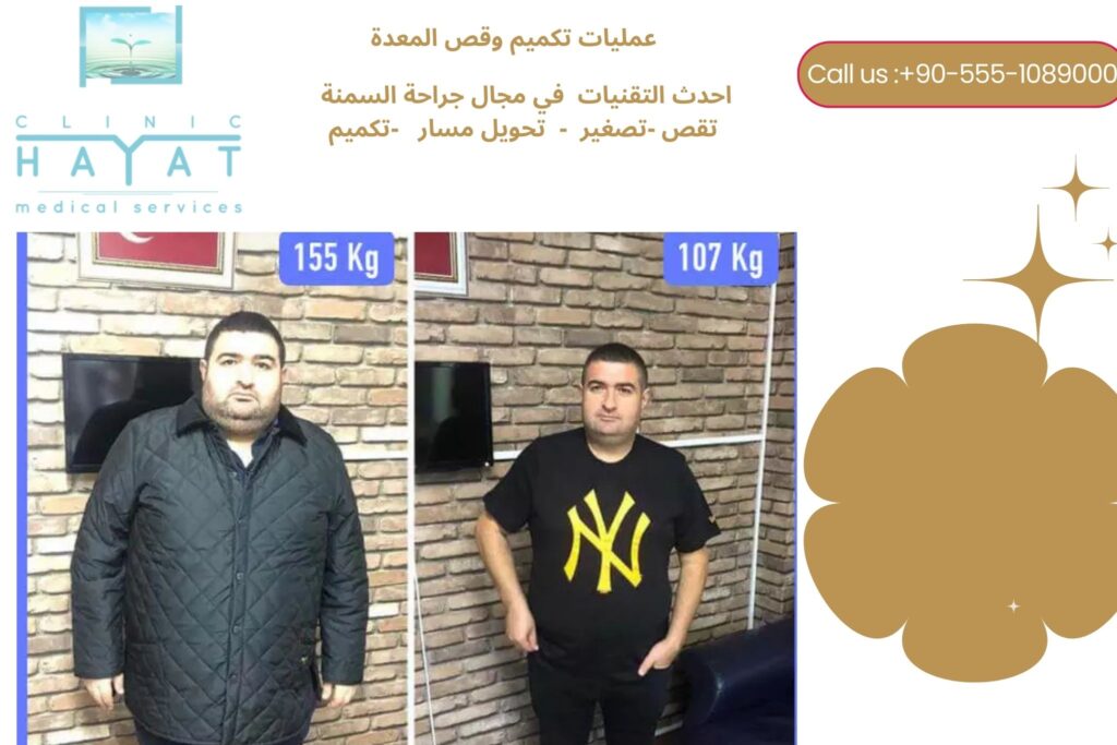 صور قبل وبعد عملية تصغير المعدة في تركيا