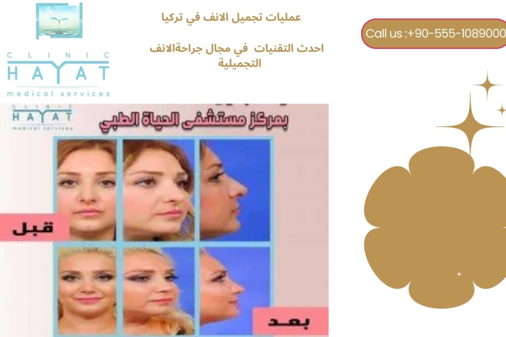 عملية تجميل الأنف في تركيا