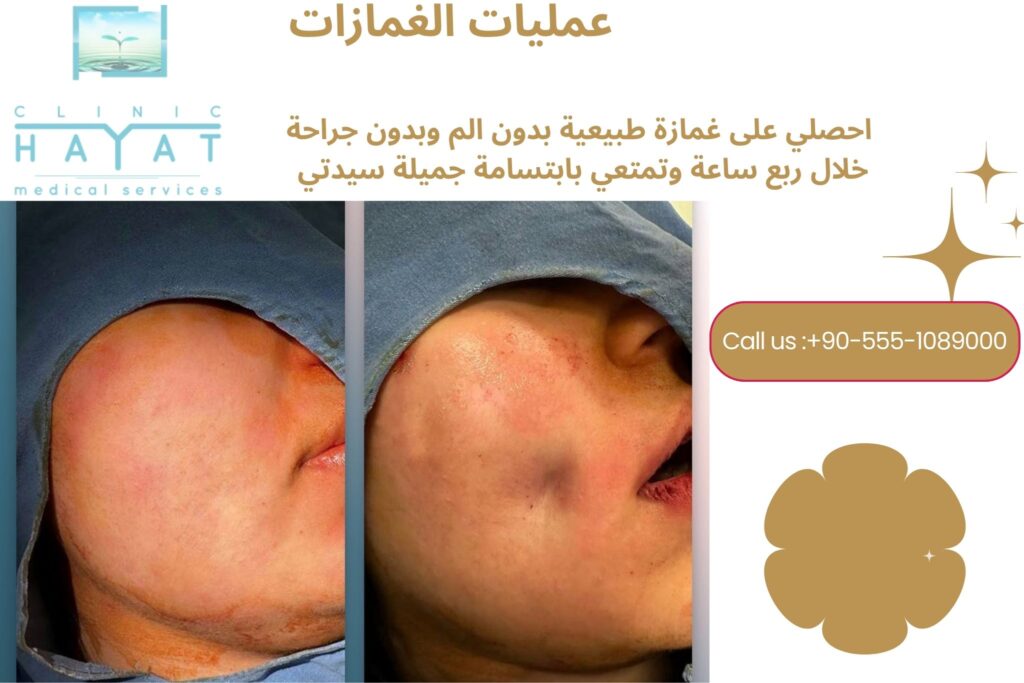 عملية الغمازات في تركيا