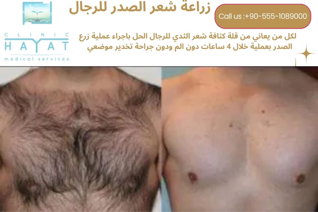 زراعة شعر الصدر في تركيا