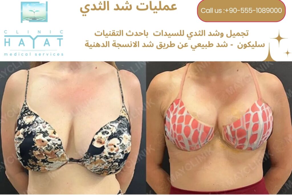 شد ورفع الثدي في تركيا