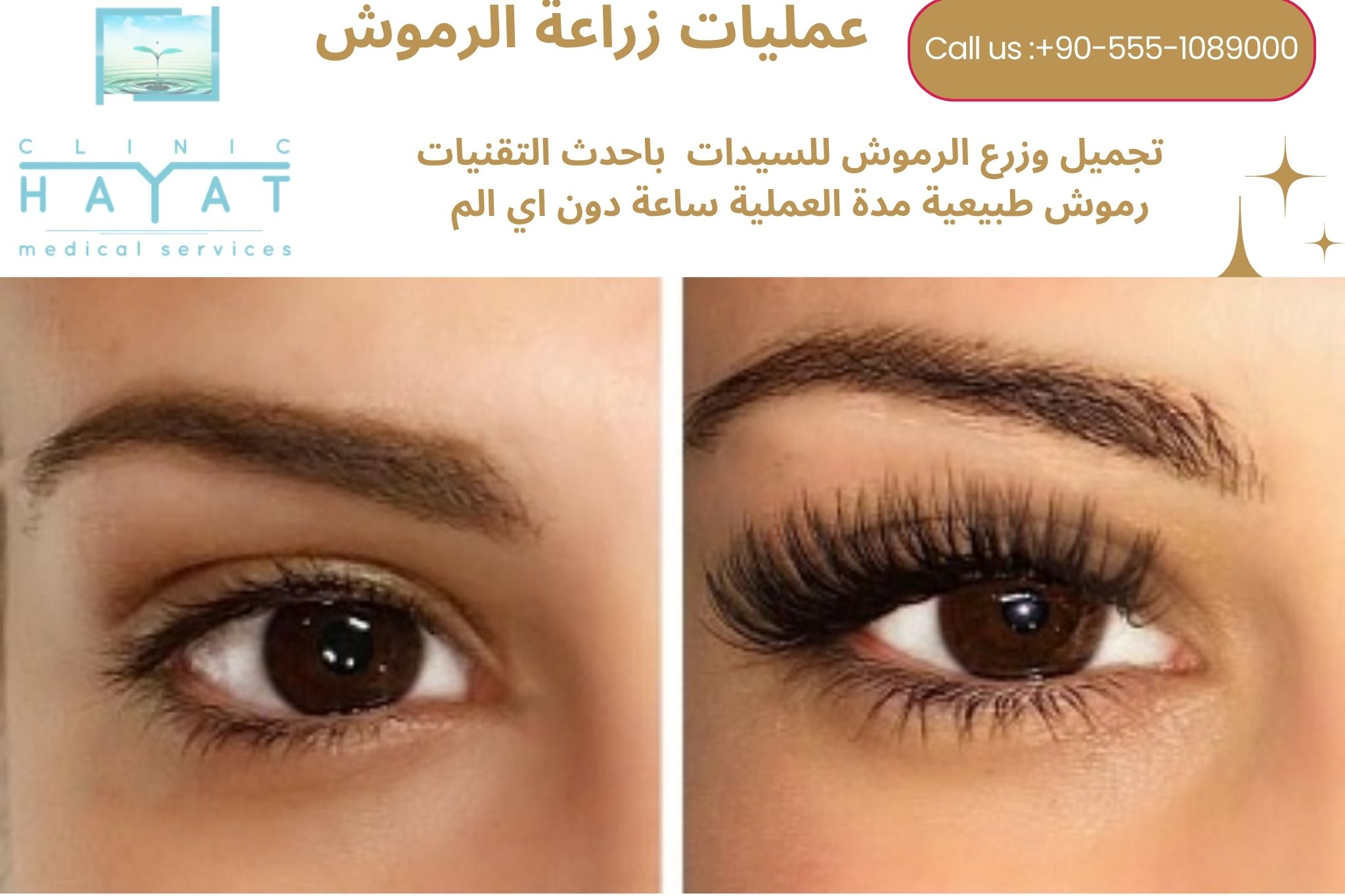 زراعة الرموش في تركيا