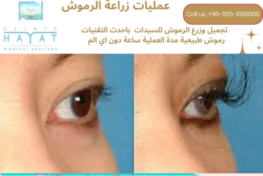 زراعة الرموش في تركيا