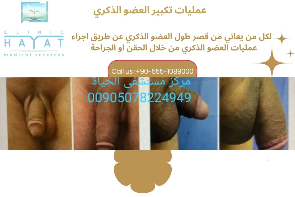 تطويل وتكبير العضو الذكري في تركيا