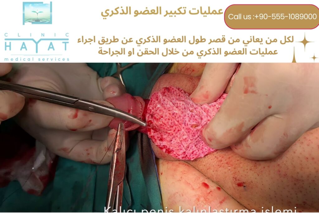 تطويل وتكبيرالعضوالذكري في تركيا