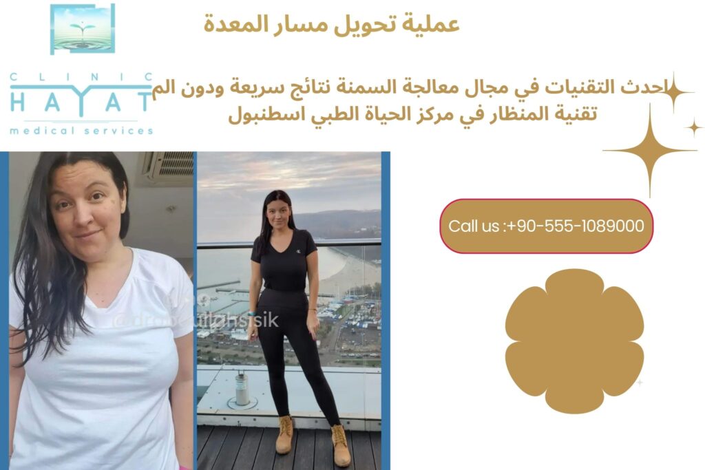 عملية تحويل مسار المعدة في تركيا