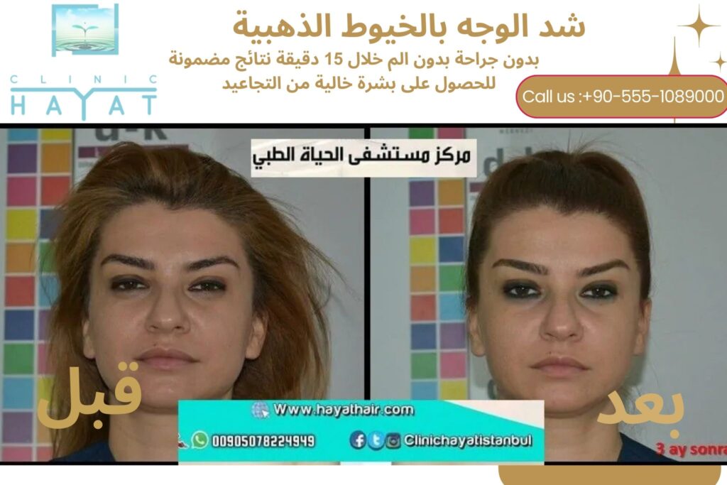 شد الوجه بالخيوط الذهبية الفرنسية في تركيا