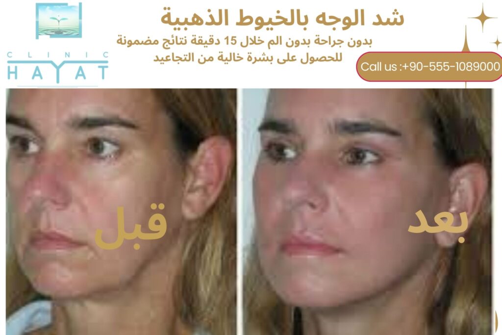 شد الوجه بالخيوط الذهبية الفرنسية في تركيا