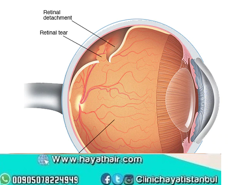 علاج شبكية العين في تركيا