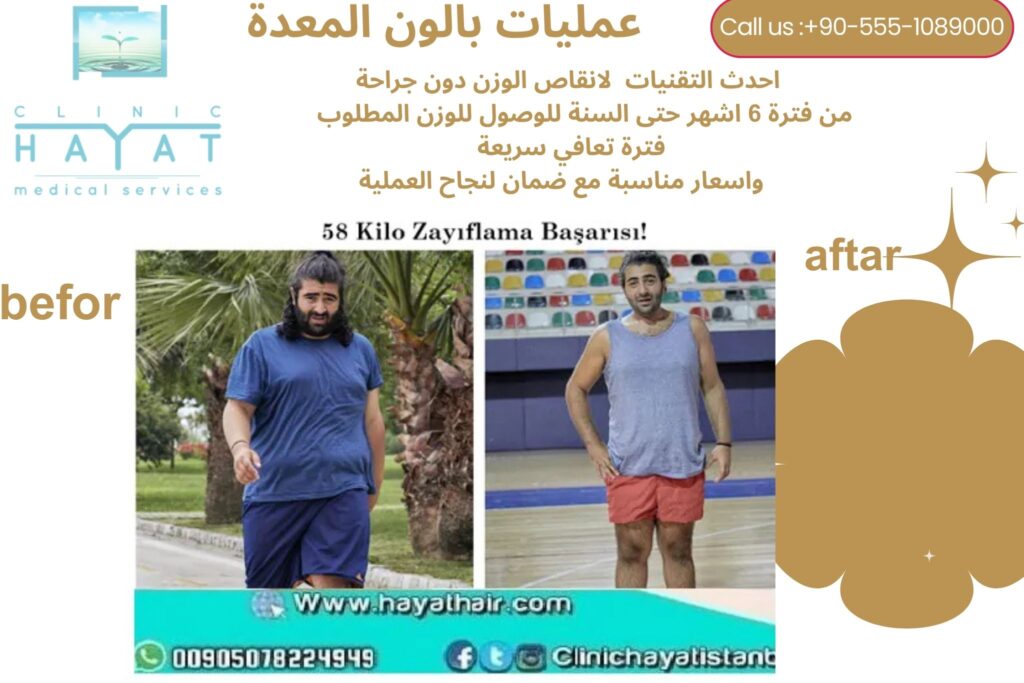 عملية بالون المعدة في تركيا