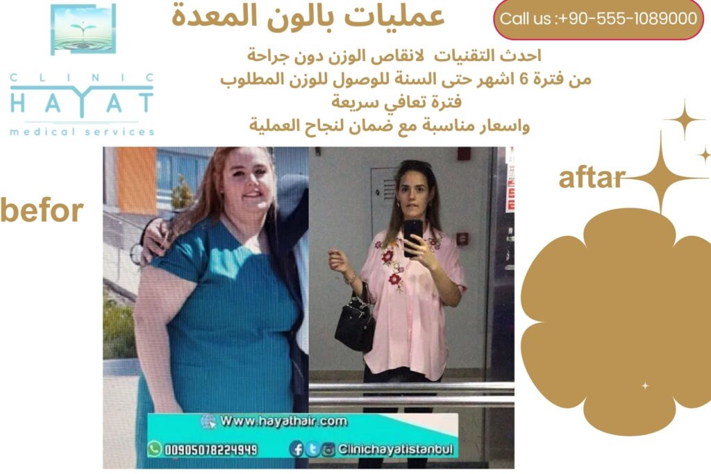 عملية بالون المعدة في تركيا