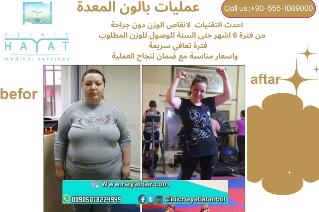 صور قبل وبعد عملية بالون المعدة في تركيا