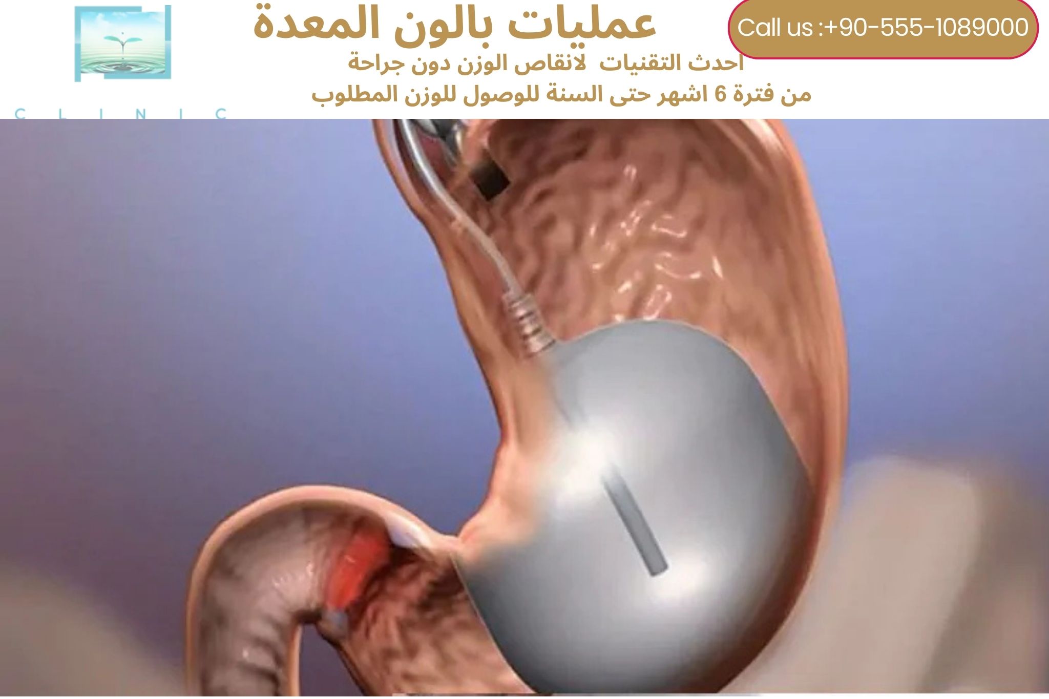 عملية بالون المعدة في تركيا