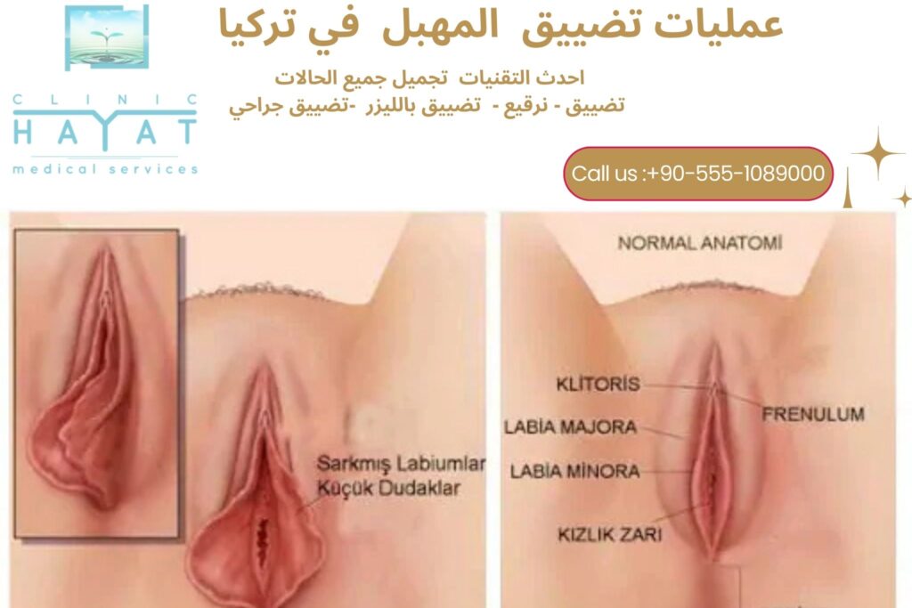 تضييق المهبل في تركيا