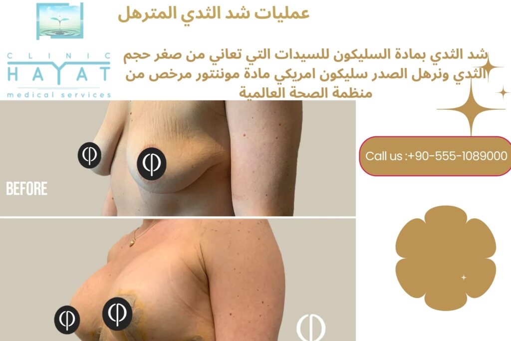 شد الصدر بالسليكون في تركيا