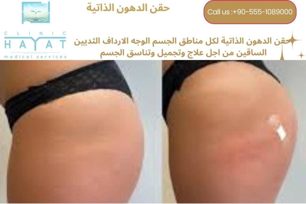 حقن الدهون الذاتية للمؤخرة