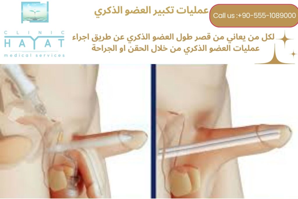 عملية تكبير القضيب