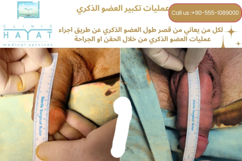 عملية تكبير القضيب