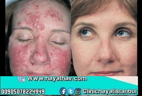 معالجة حب الشباب في تركيا مركز مستشفى الحياة الطبي للتجميل والاختصاصات الطبية