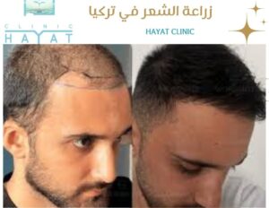 زراعة الشعر في تركيا