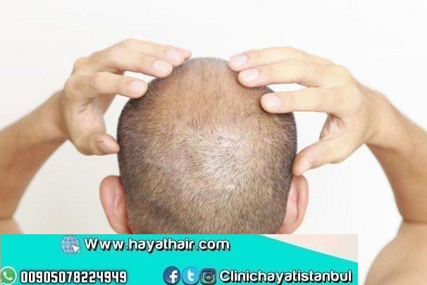 طرق علاج الحكة بعد زراعة الشعر
