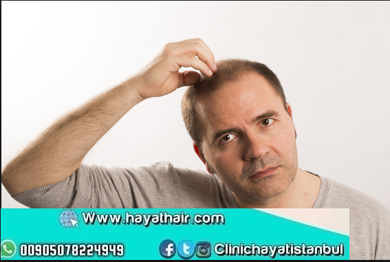 طرق علاج الحكة بعد زراعة الشعر