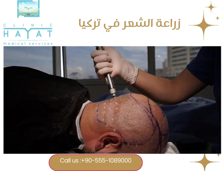 زراعة الشعر في تركيا