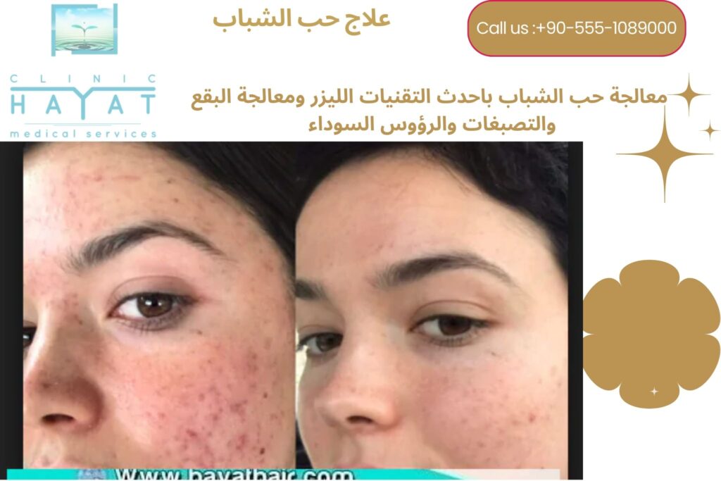 معالجة حب الشباب في تركيا