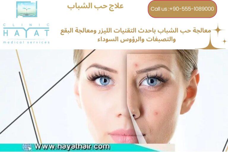 معالجة حب الشباب في تركيا