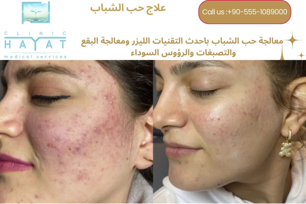 معالجة حب الشباب في تركيا