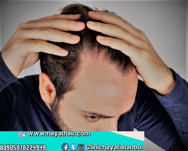 علاج الشعر الخفيف من الأمام