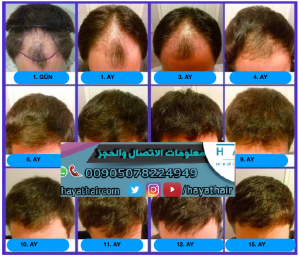 زراعة الشعر في تركيا 2023