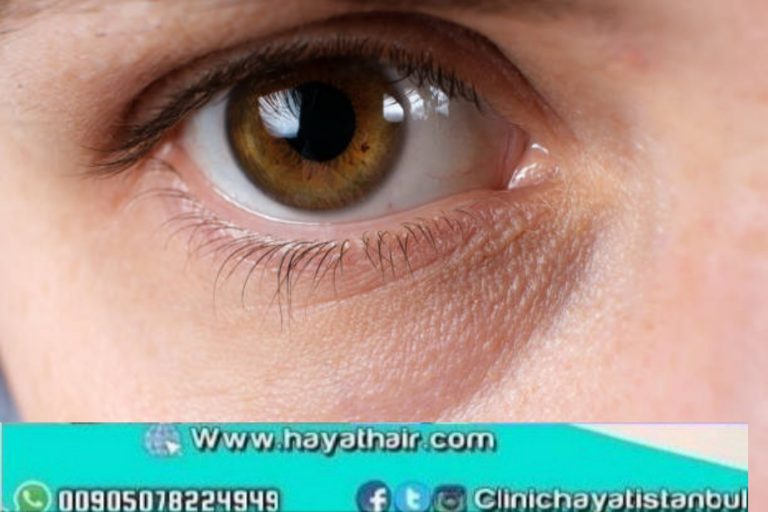 ازالة السواد حول العين | الأسباب والعلاج