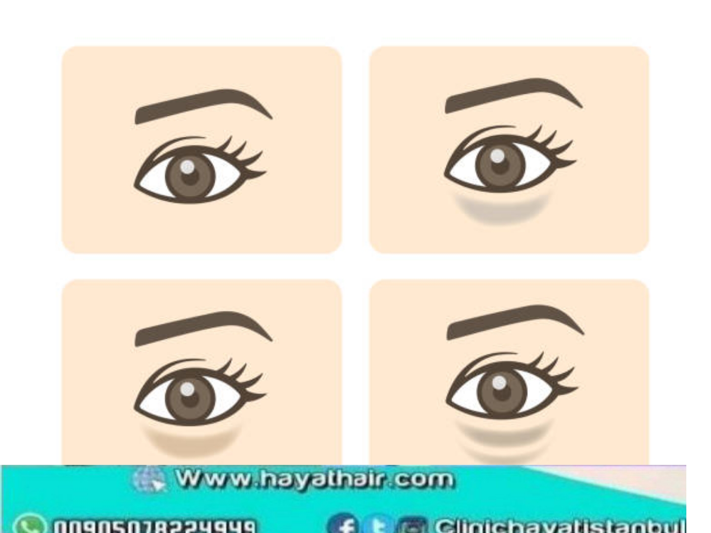 ما هي الهالات السوداء حول العين