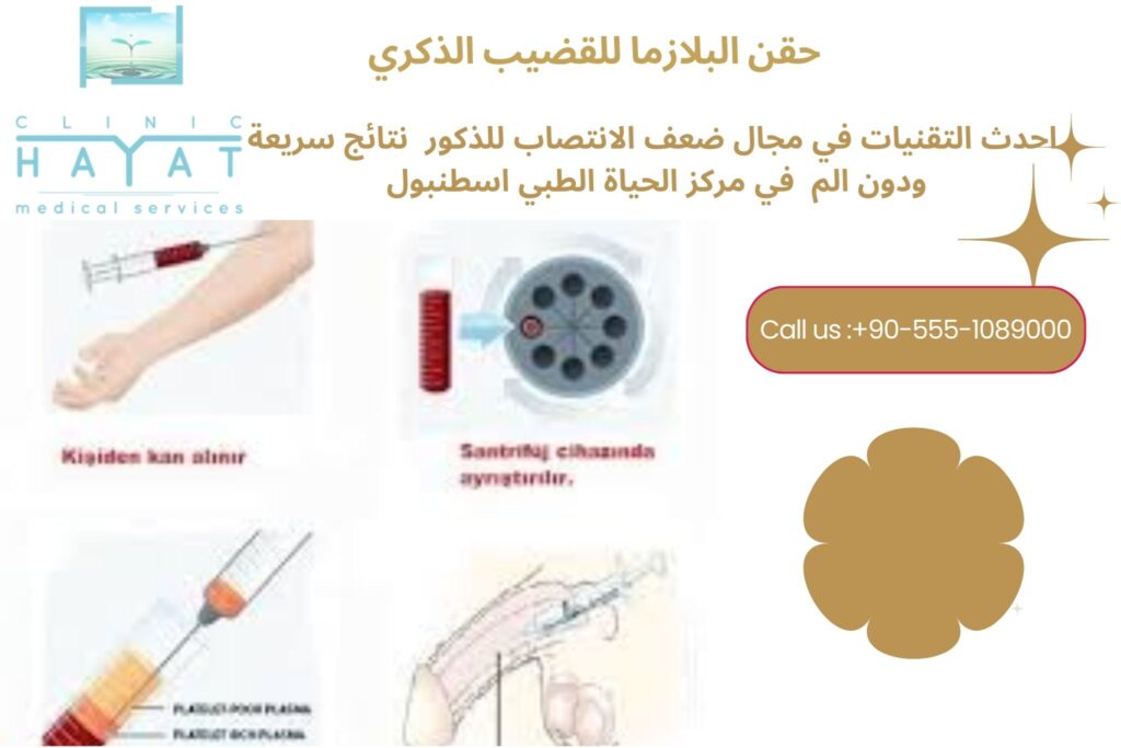 حقن البلازما للعضو الذكري في تركيا