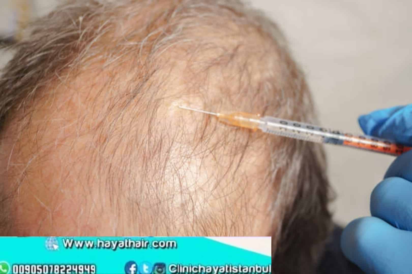 الآثار الجانبية لعملية زراعة الشعر في اوروبا