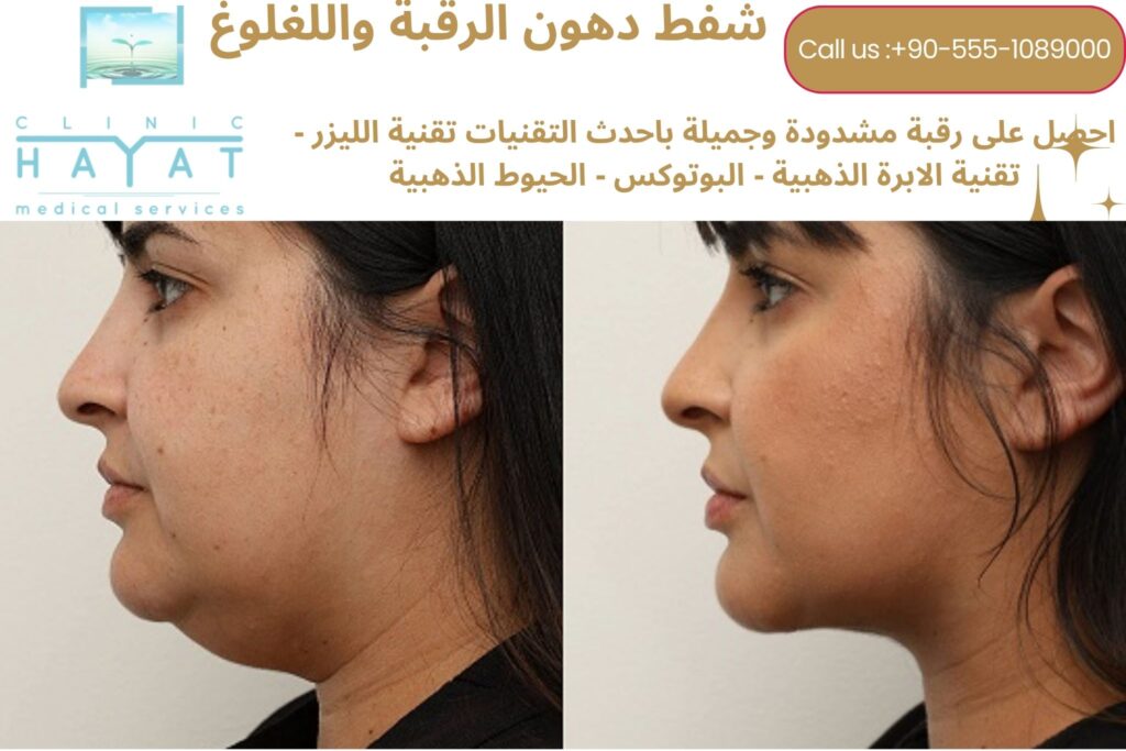 شفط دهون اللغلوغ في تركيا