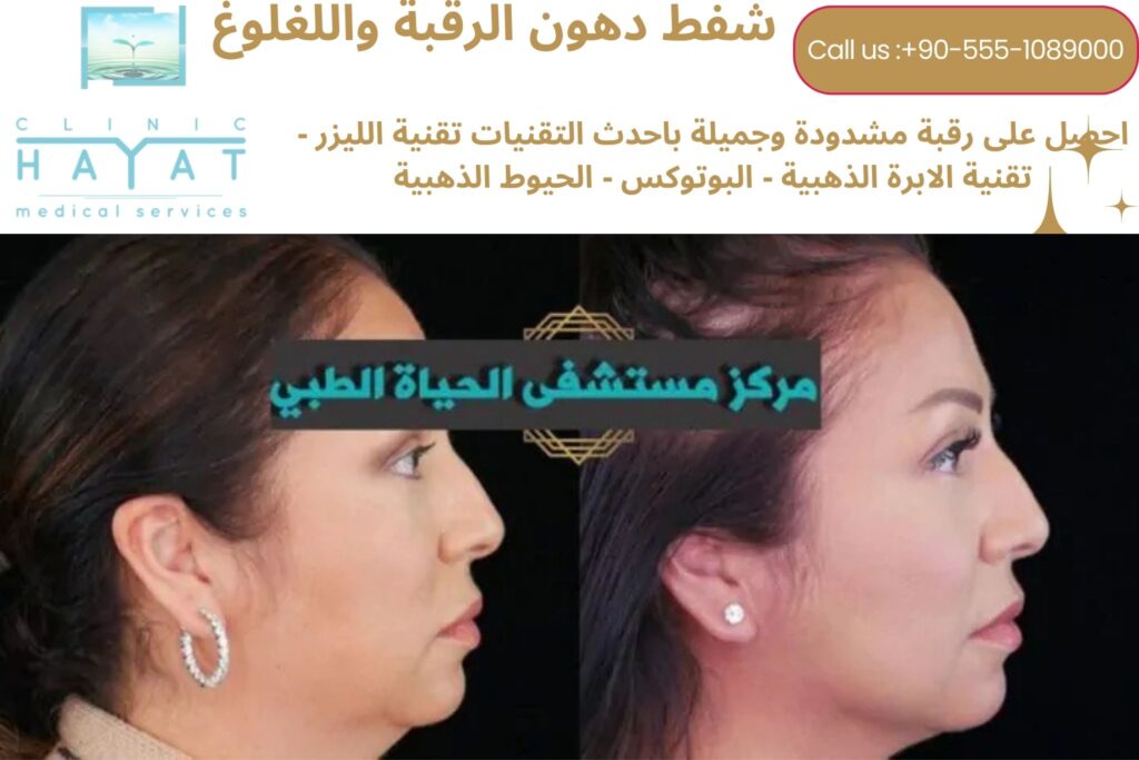 شفط دهون اللغلوغ في تركيا