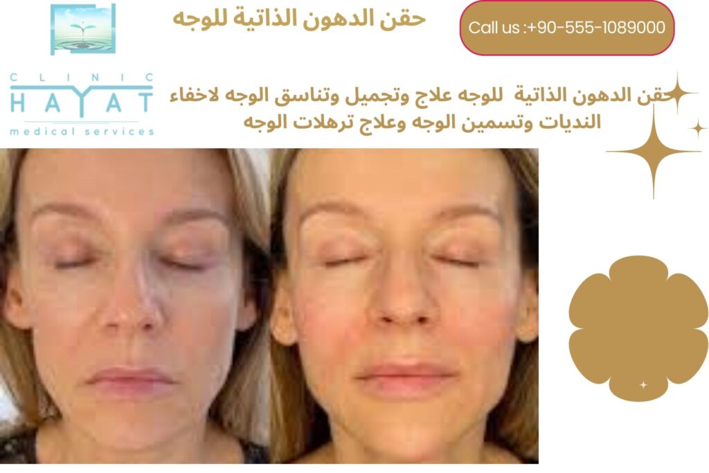 حقن دهون الوجه في تركيا