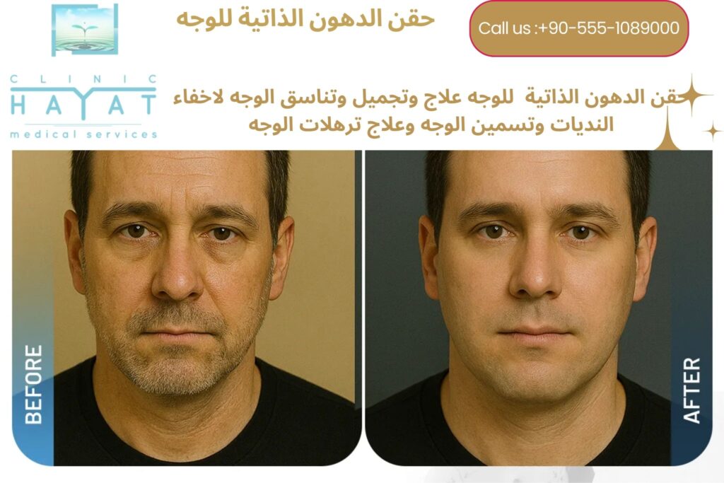 حقن دهون الوجه في تركيا